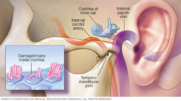 Causas comunes del pitido en los oídos y su relación⁤ con la salud