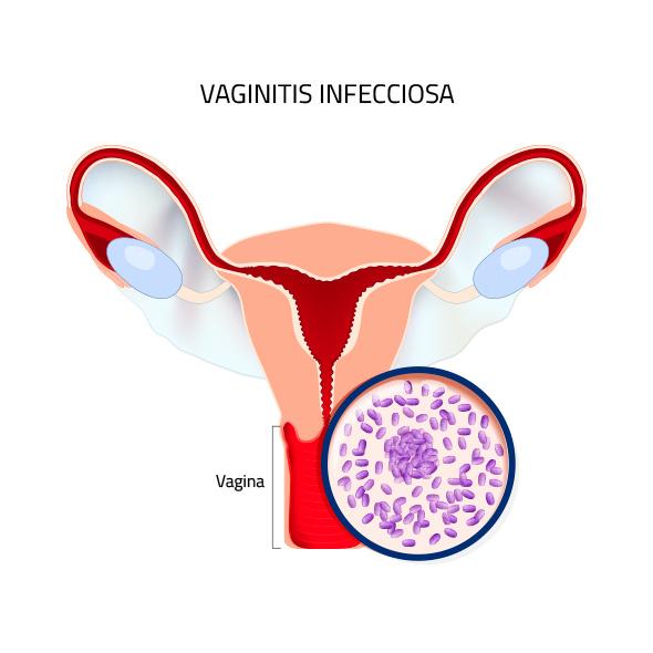 Consejos para Prevenir Infecciones Menstruales