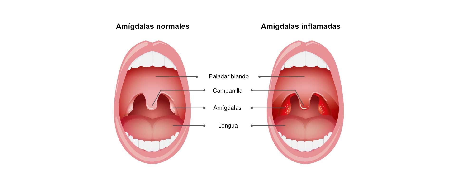 Prevención y Cuidados para una Garganta Saludable