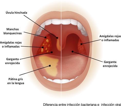 Causas Comunes del Dolor de Garganta al​ Tragar