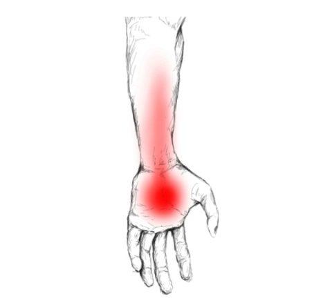 Estrategias⁣ de Alivio y Prevención para el Dolor Palmar