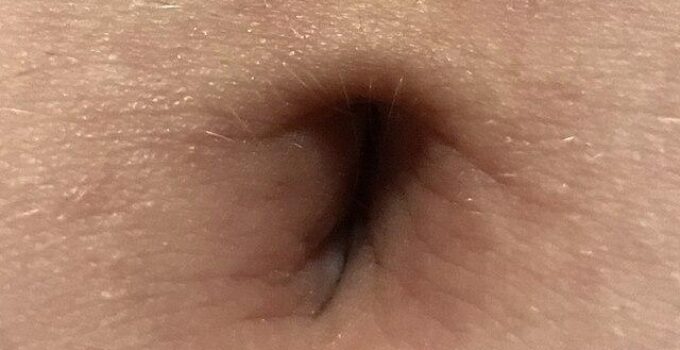porque me duele el ombligo cuando me estiro