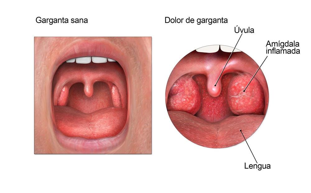 Consejos para Prevenir el Dolor de Garganta en el Futuro